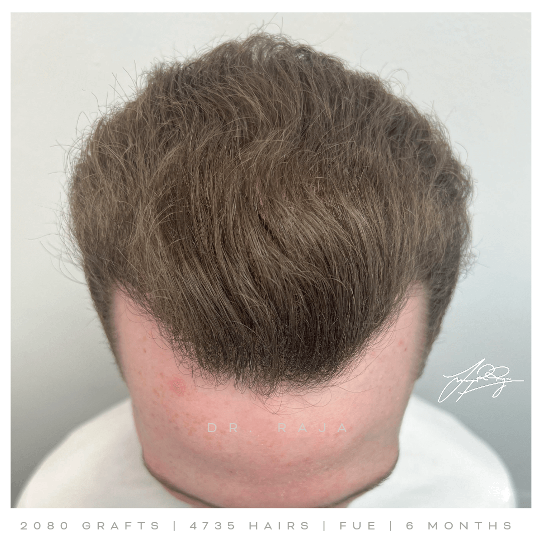 Dr. Raja FUE After Dr. Raja FUE After result