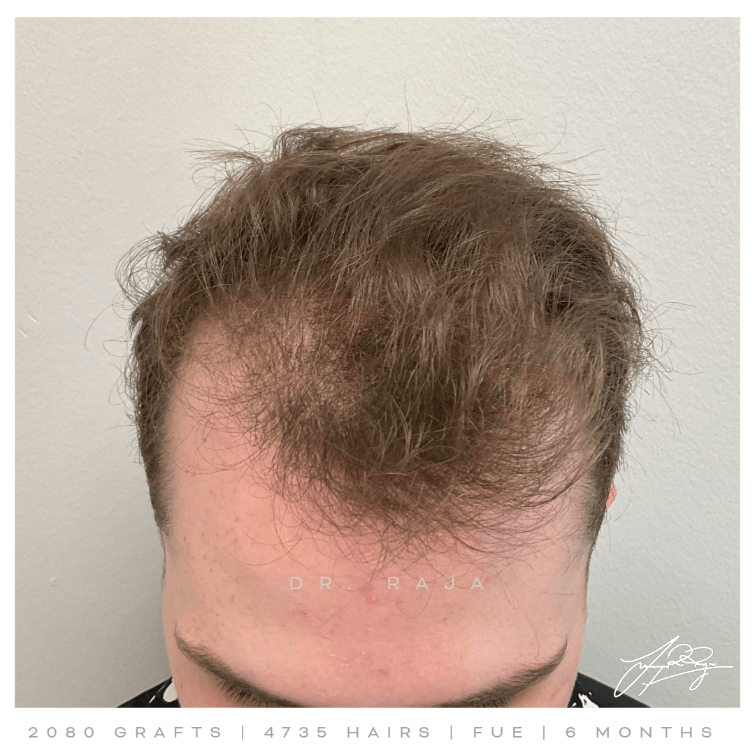 Dr. Raja FUE Before Dr. Raja FUE Before