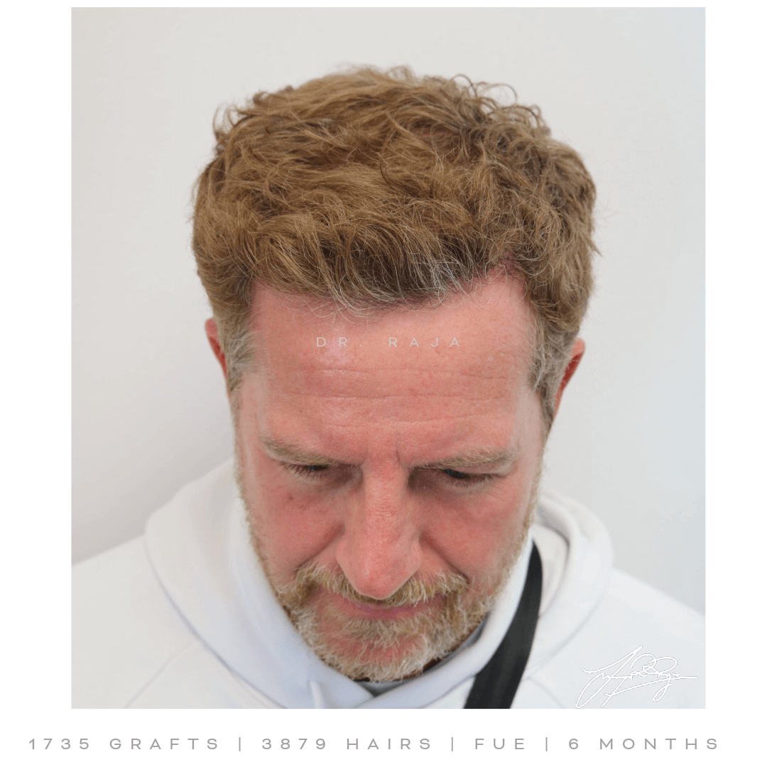 Dr. Raja FUE result Dr. Raja FUE Result