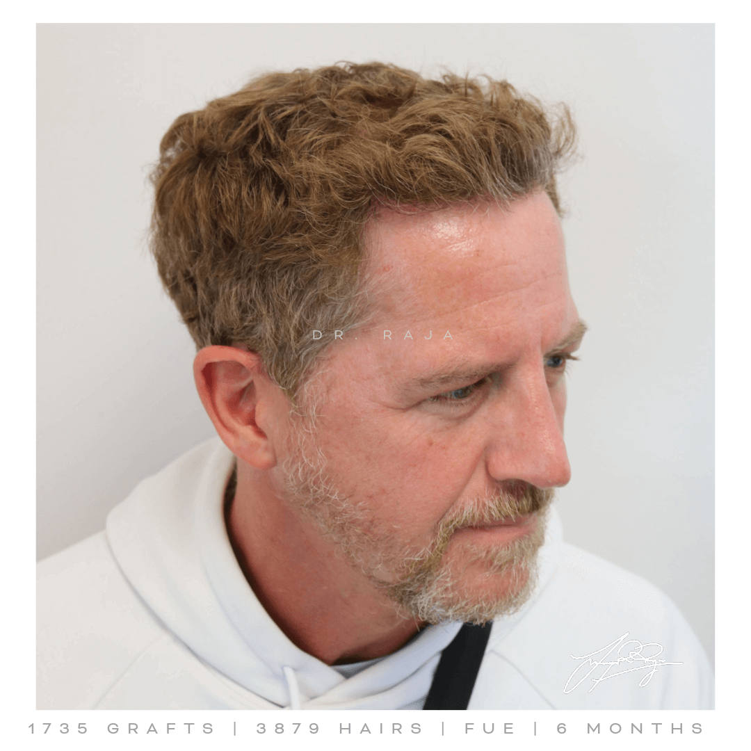 Dr. Raja FUE After Results Dr. Raja FUE After