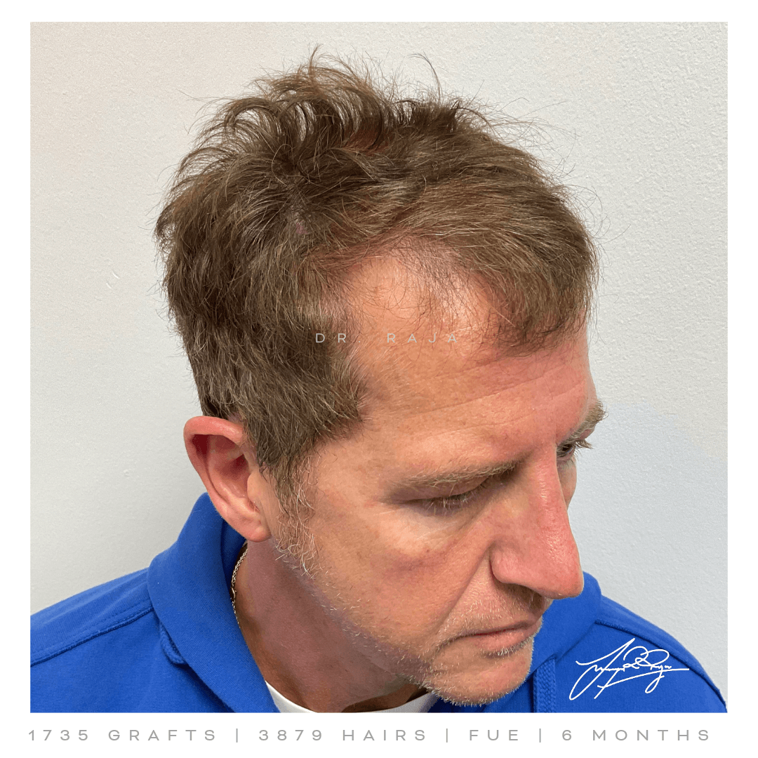 Dr. Raja FUE Before Result Dr. Raja FUE Before