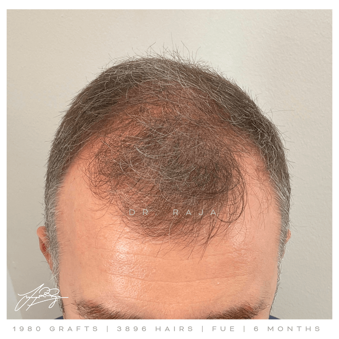dr raja FUE before