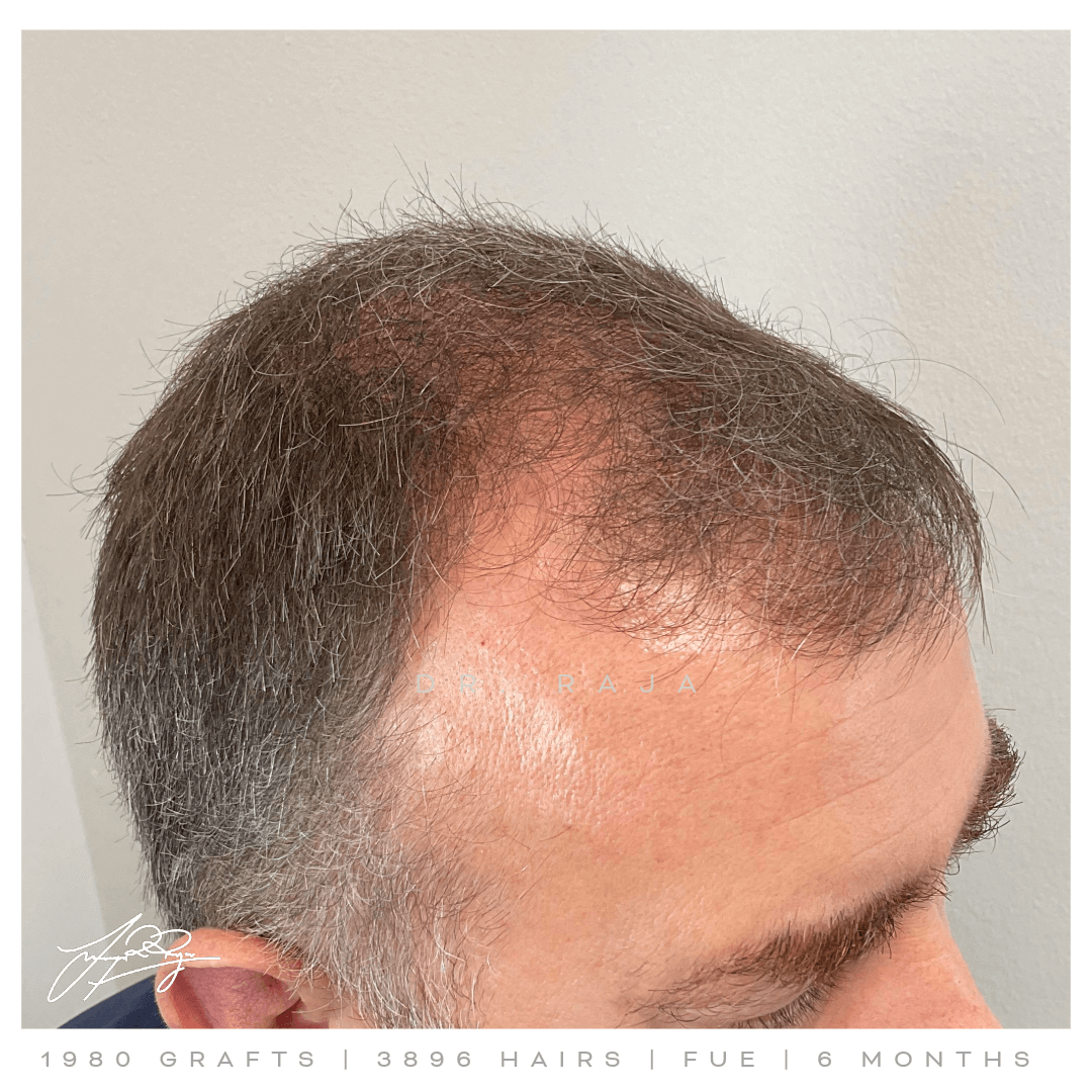 dr raja FUE before