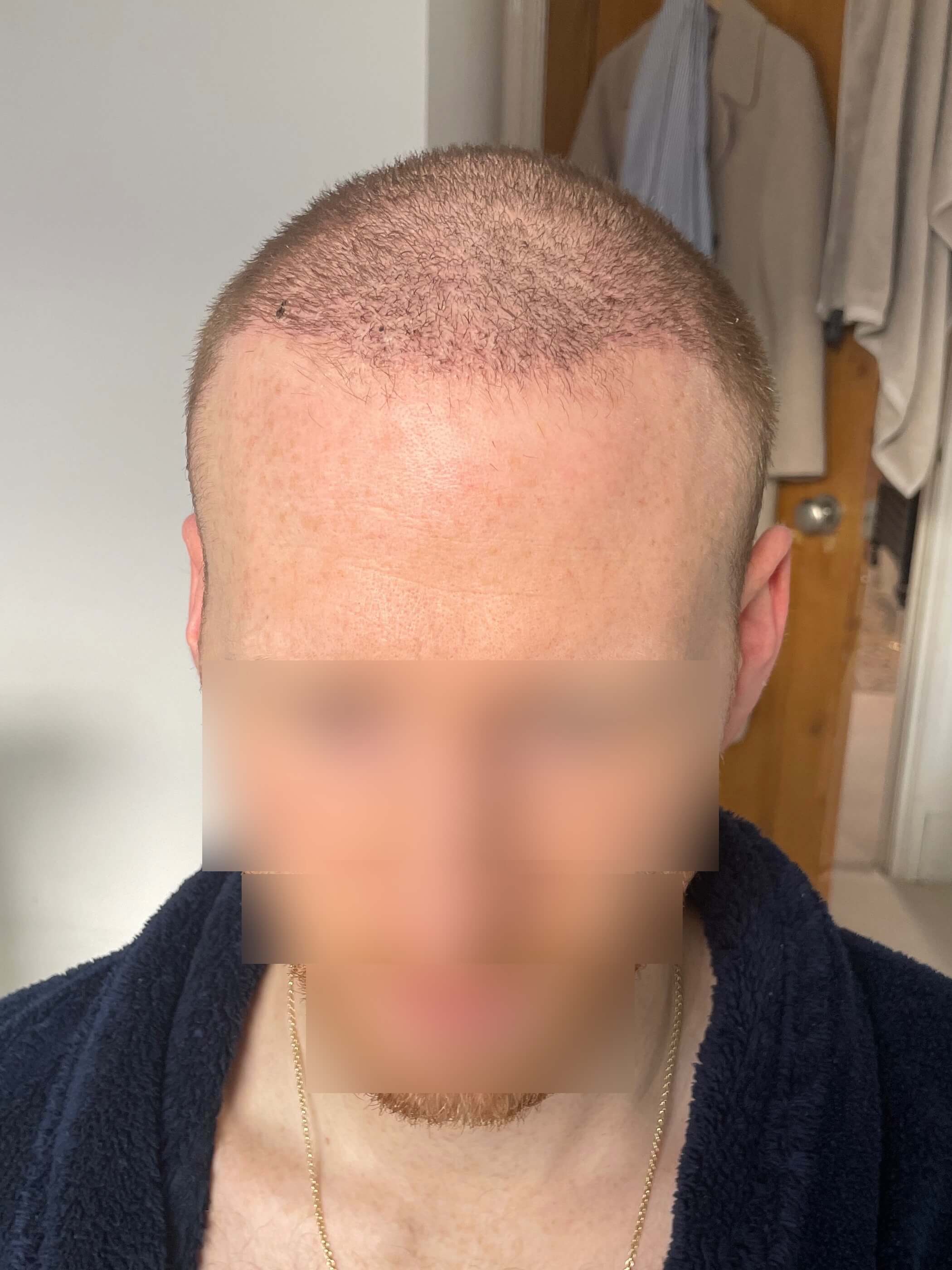 FUE Hair transplant 2 weeks post-op