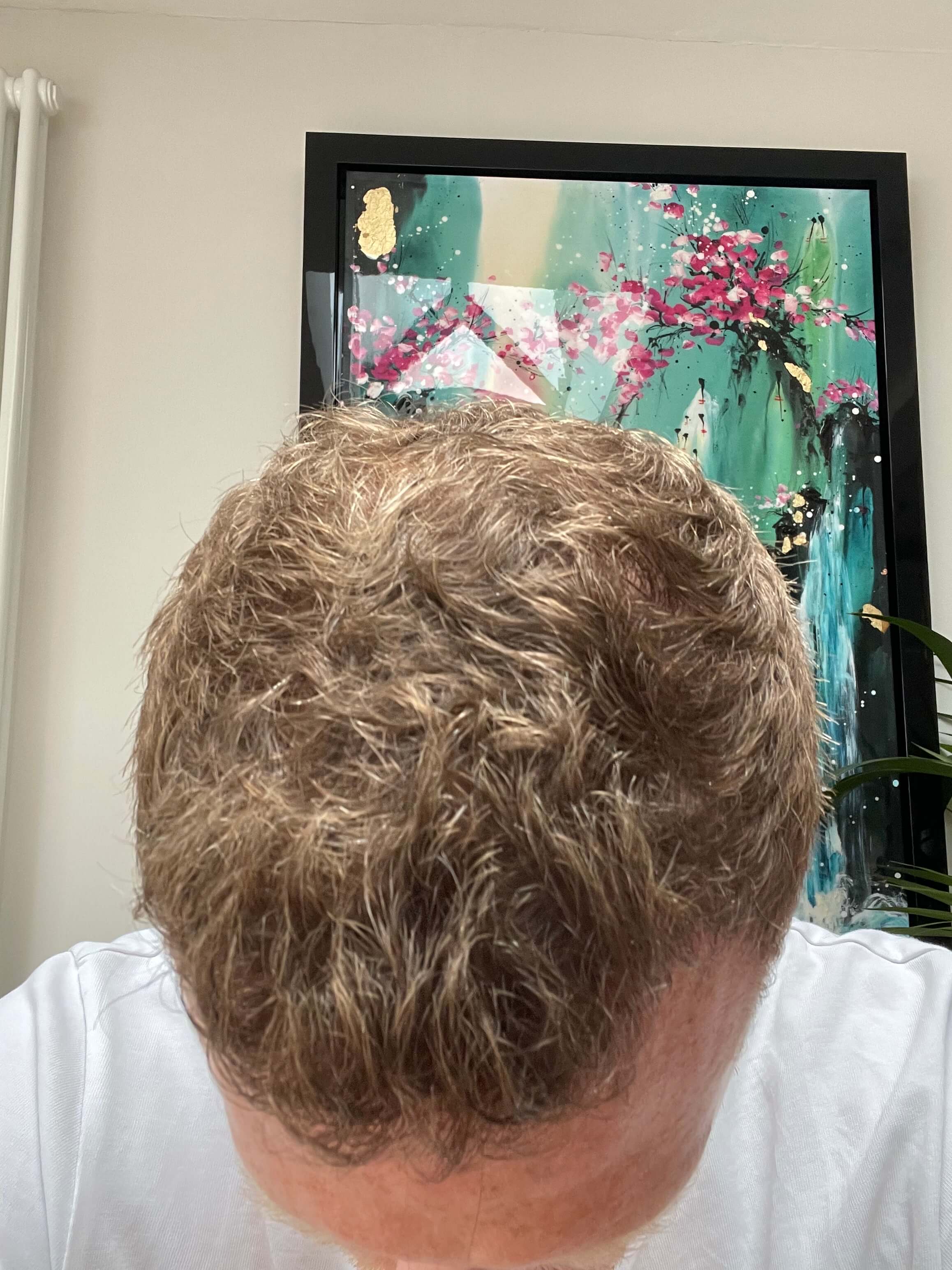 FUE 6 months Dr. Raja