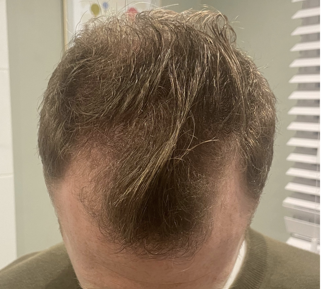 Hair transplant result 10